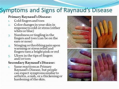 Raynaud’s Disease & Syndrome: Symptoms, Causes, Treatment